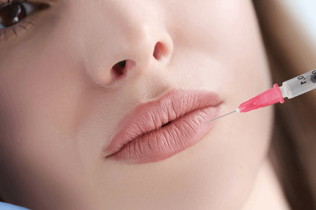 Lip Filler Treatment in Lucknow 
